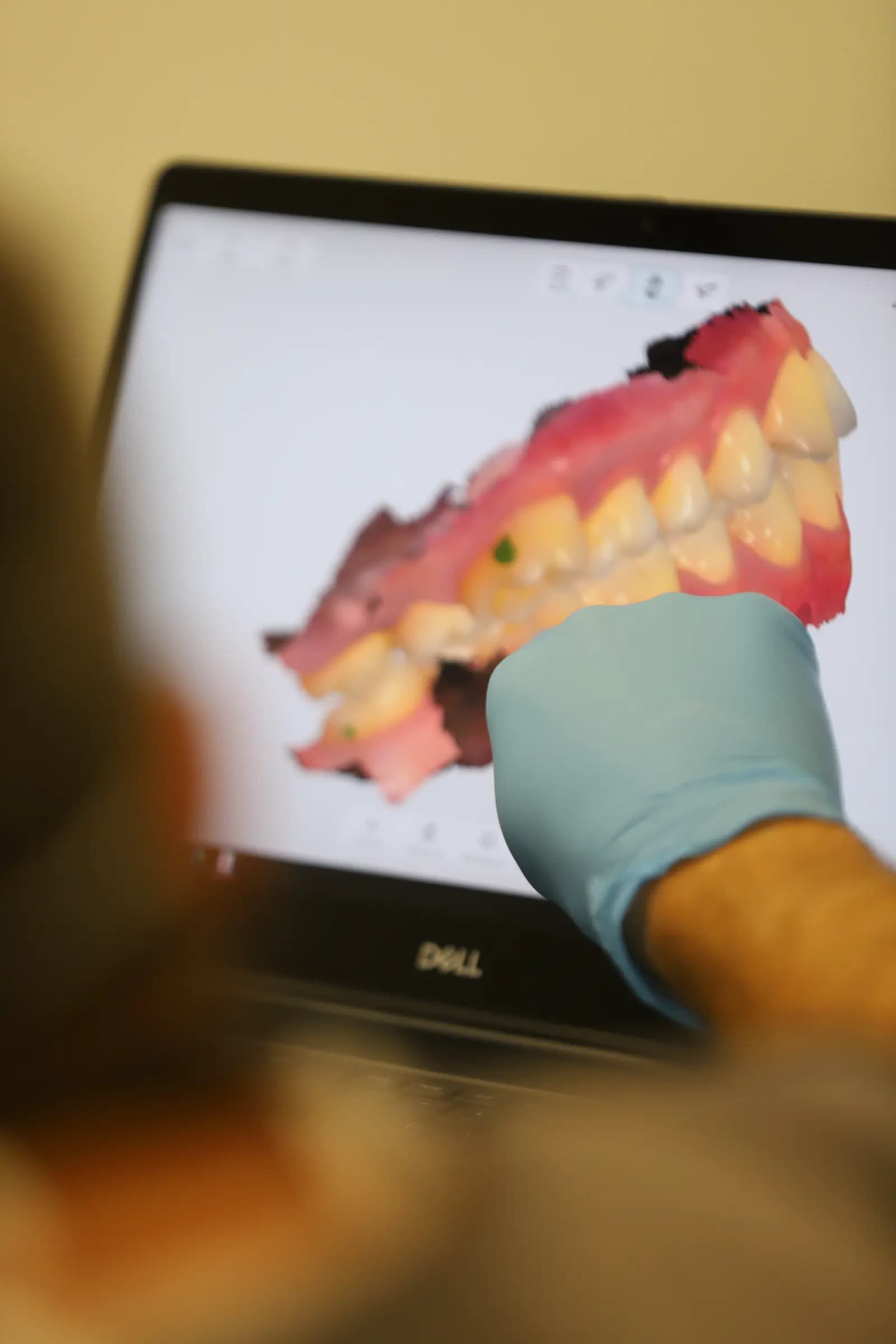 3D tooth scan on a laptop with a gloved hand