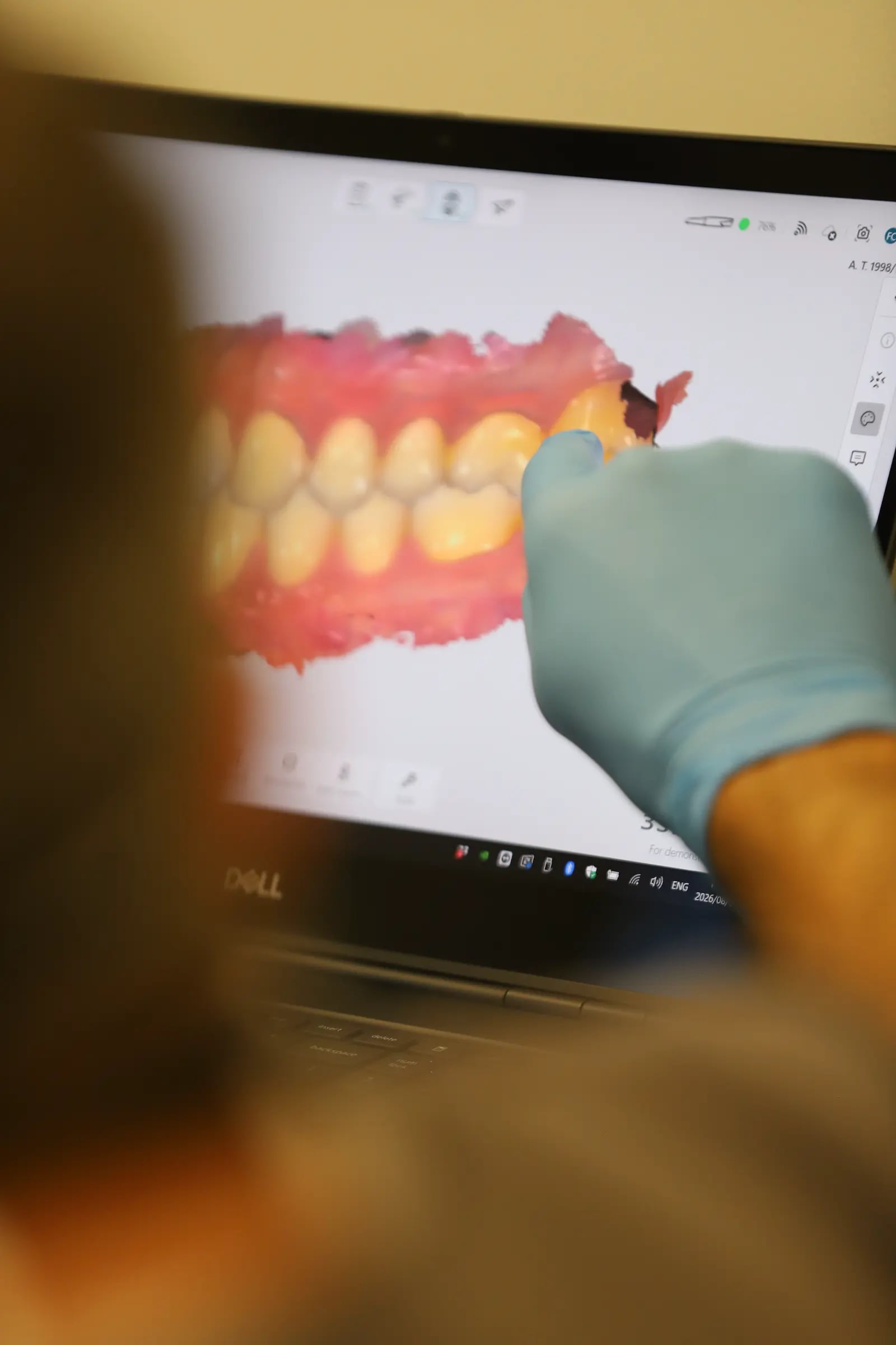 3D tooth scan on a laptop with a gloved hand