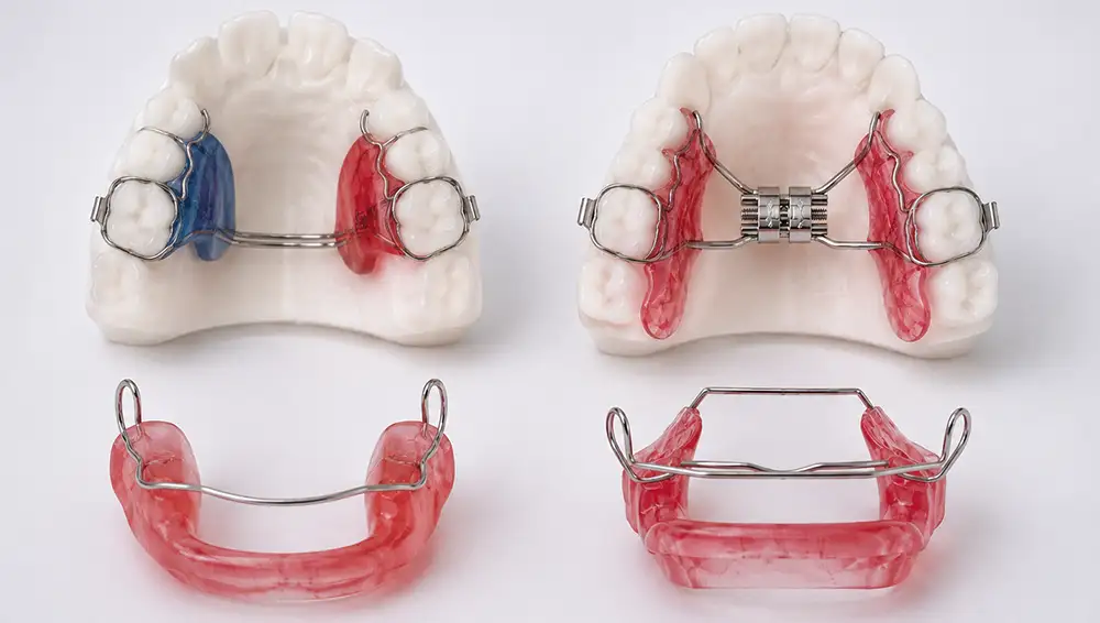 Orthodontic expanders: Hyrax, Haas and quad helix at Adam Labs