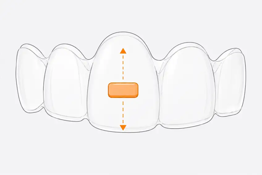 Horizontal attachment on tooth, extrusion, intrusion and vertical control