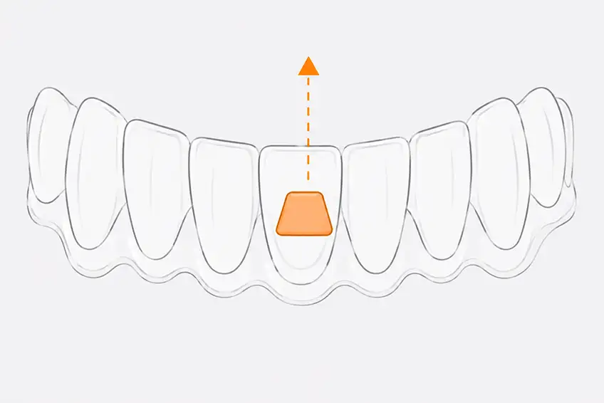 Mandibular extrusion attachment on lower tooth