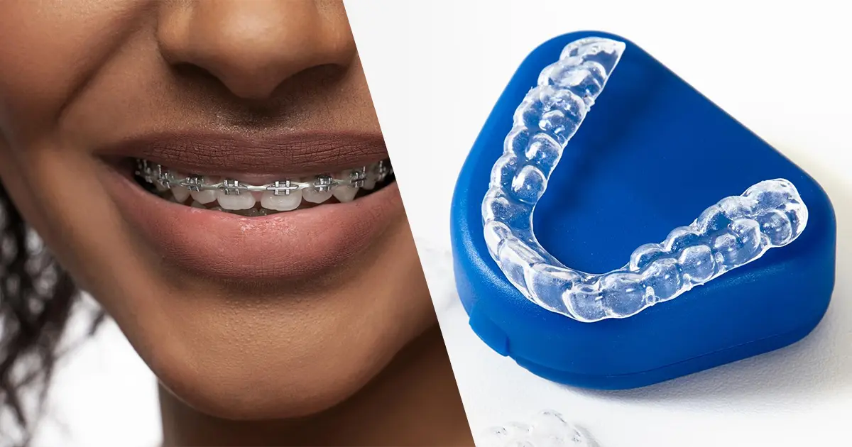 Clear Aligners vs Braces