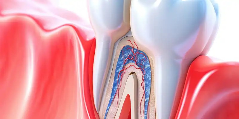 Root Canal Therapy