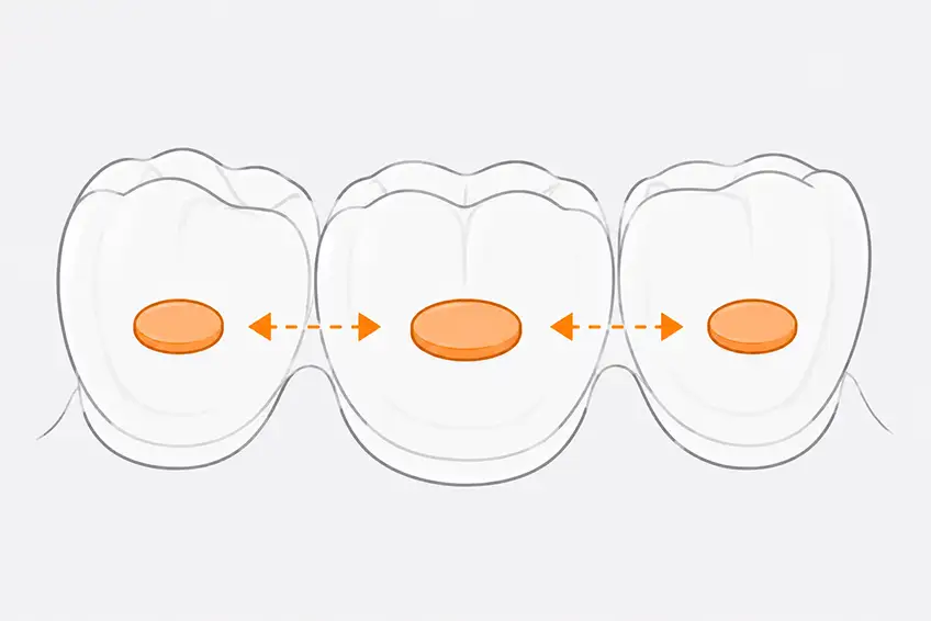 Stability attachment on tooth, anchorage, en-masse and retention