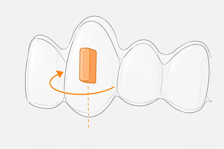 Vertical attachment on tooth, rotation, uprighting and torque