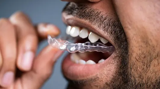 Mia Aligners